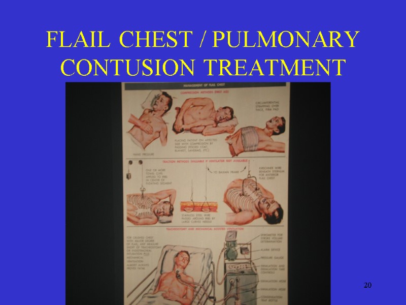 20 FLAIL CHEST / PULMONARY CONTUSION TREATMENT